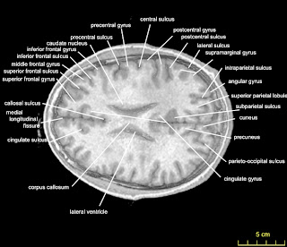 Brain Anatomy Ct Scan