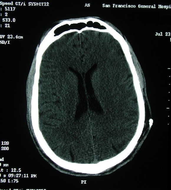 Brain Anatomy Ct Scan