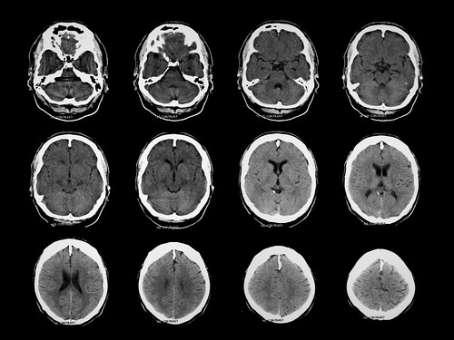 Brain Anatomy Ct Scan