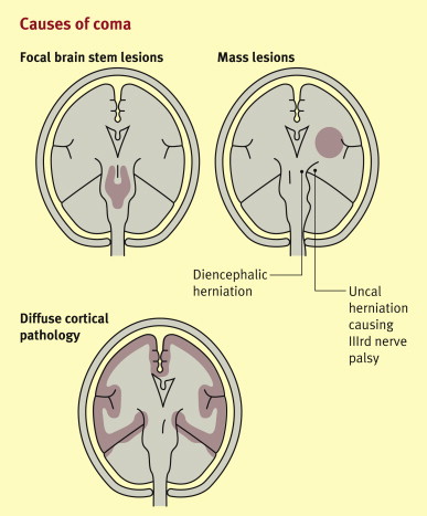 Brain Stem Death Causes