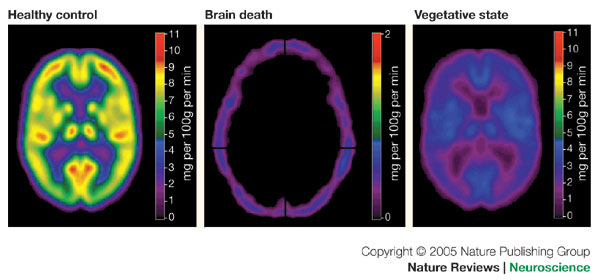 Brain Stem Death Criteria