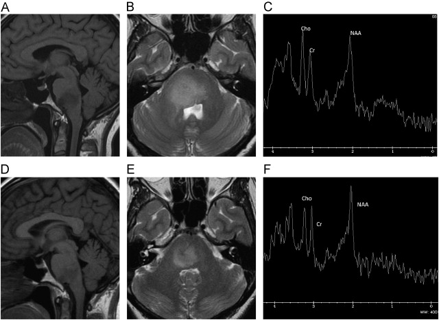 Brain Stem Glioma Adults