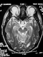 Brain Stem Glioma Adults