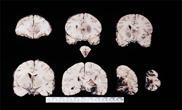 Brain Stem Glioma Adults