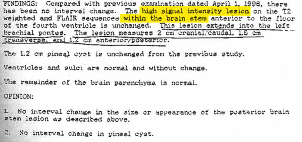 Brain Stem Glioma Statistics