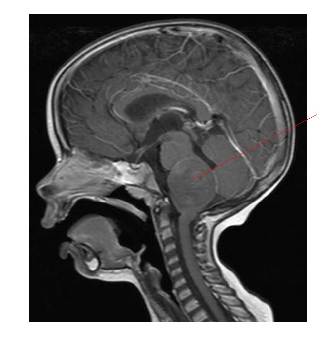 Brain Stem Glioma Statistics