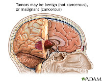 Brain Stem Glioma Statistics