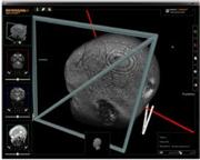 Brain Stem Glioma Treatment