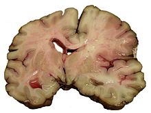 Brain Stem Stroke Coma