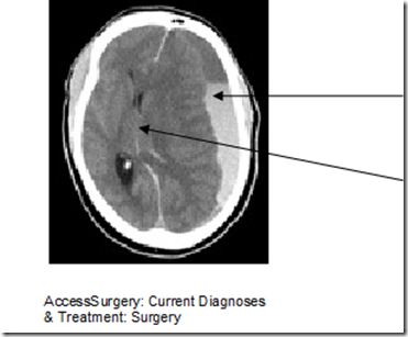 Brain Stem Stroke Coma