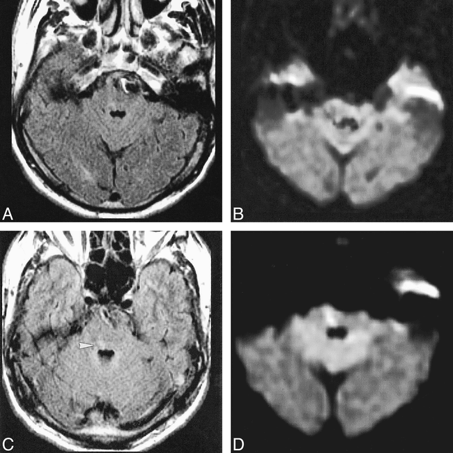 Brain Stem Stroke Effects