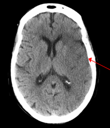 Brain Stem Stroke Effects