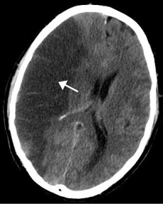 Brain Stem Stroke Effects