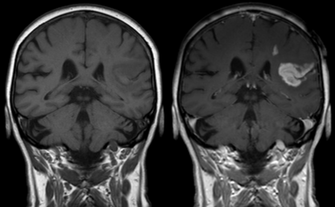 Brain Stem Stroke Icd 9