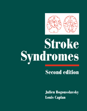 Brain Stem Stroke Syndrome