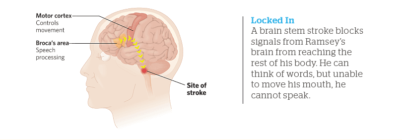 Brain Stem Stroke Syndrome