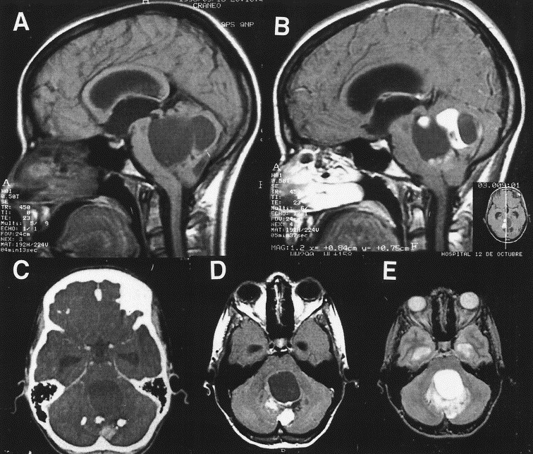 Brain Stem Tumor In Children