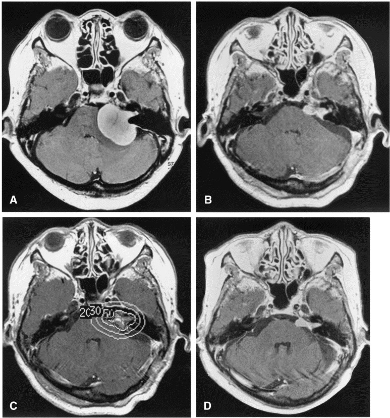 Brain Stem Tumor Surgery