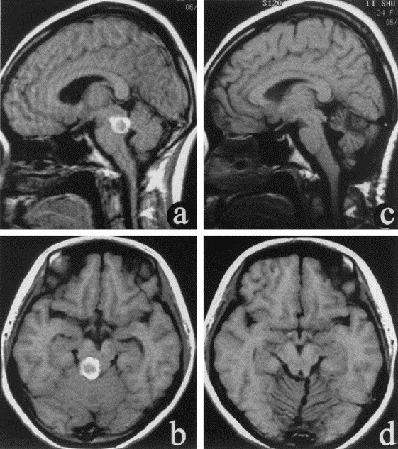 Brain Stem Tumor Surgery