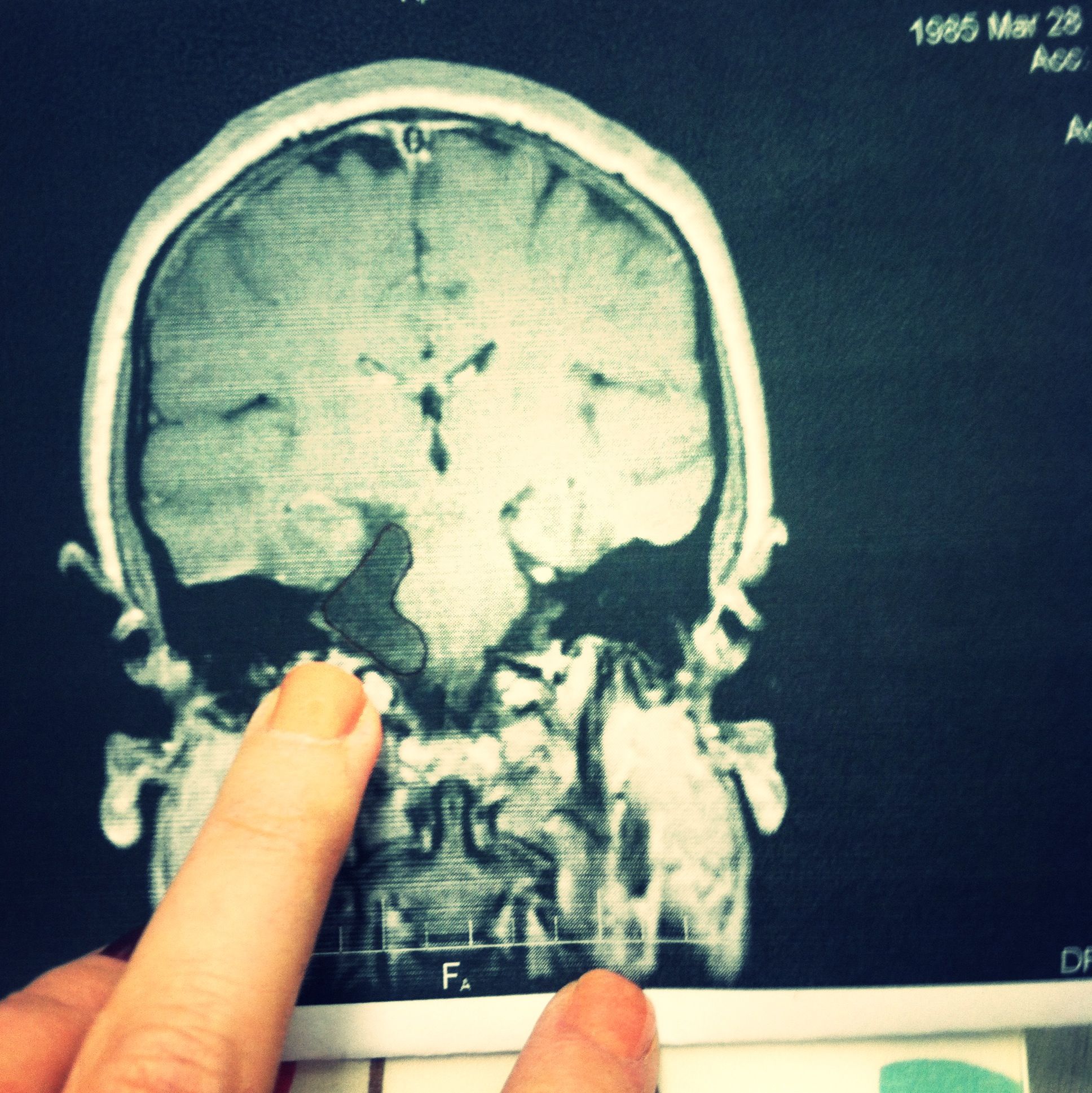 Brain Stem Tumor Surgery