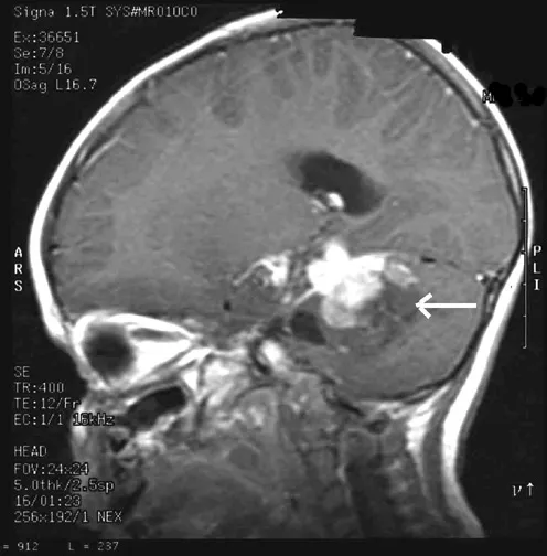 Brain Stem Tumor Symptoms