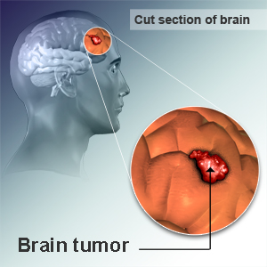 Brain Tumor