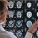 Brain Tumor Causes Vertigo