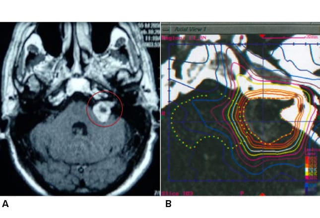 Brain Tumor Causes Vertigo