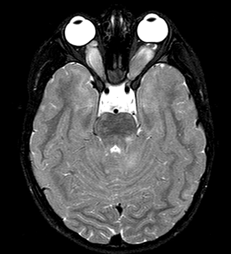 Brain Tumor Images Mri