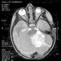 Brain Tumor Images Pictures