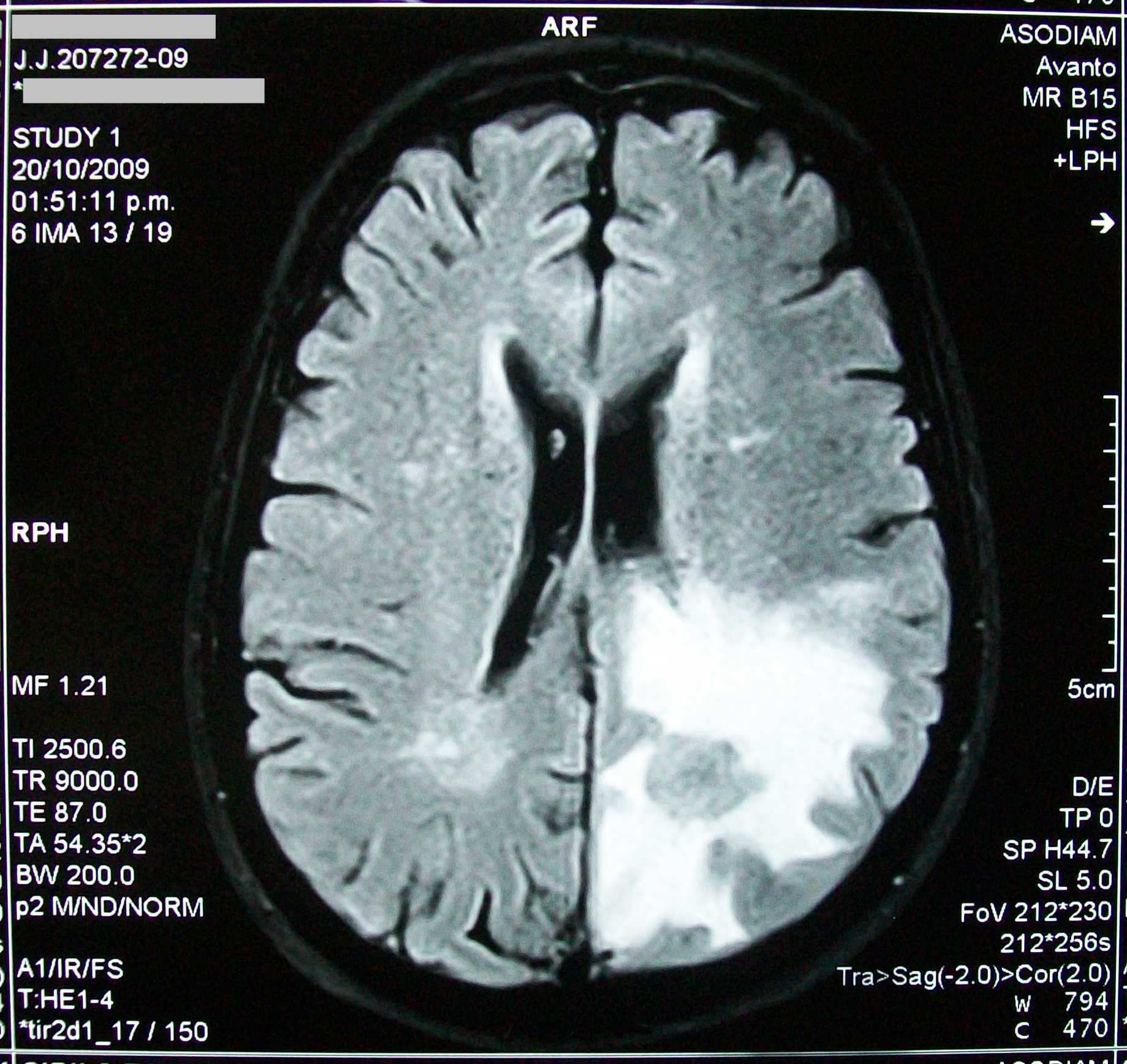 Brain Tumor Images Pictures