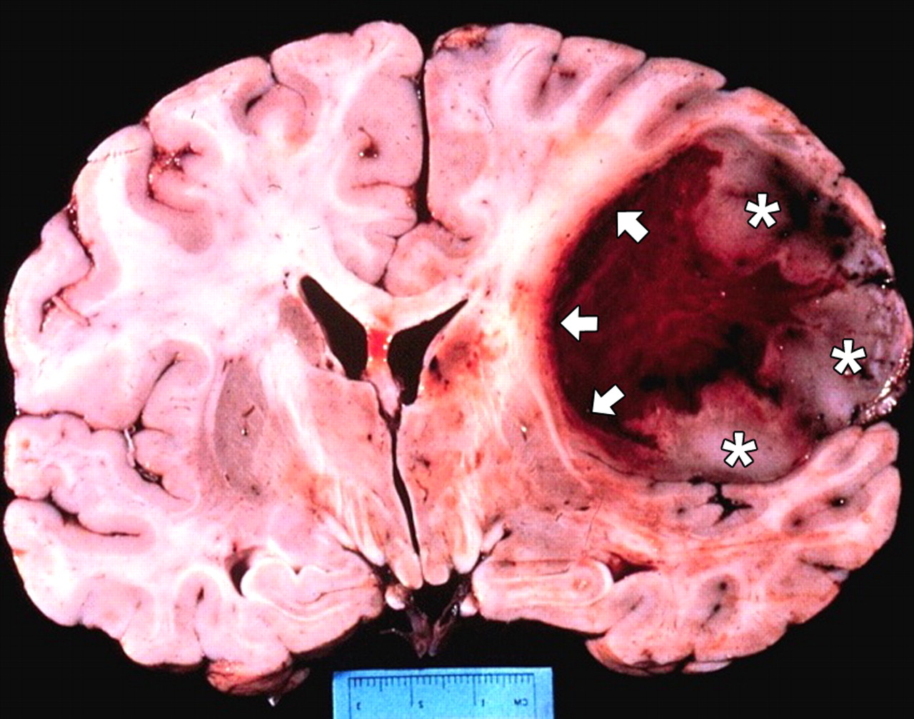 Brain Tumor Images Pictures