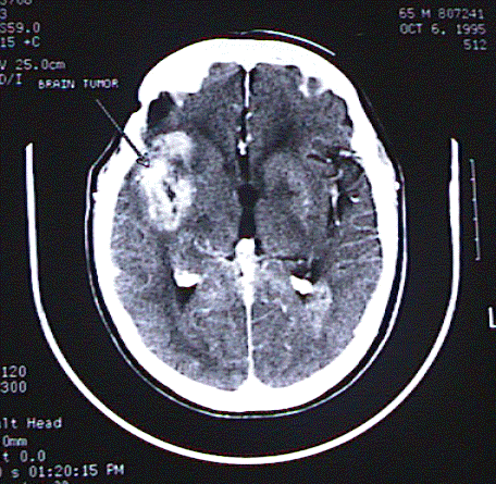 Brain Tumor Images Pictures