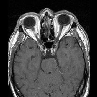 Brain Tumor Mri Database