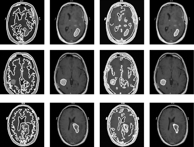 Brain Tumor Mri Database