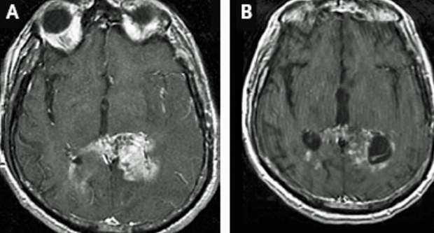 Brain Tumor Mri Database