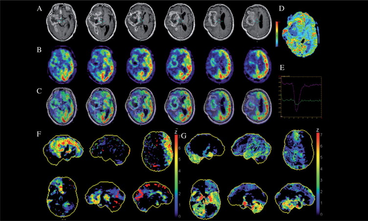 Brain Tumor Mri Database