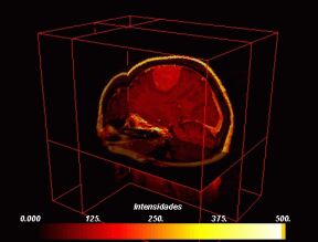 Brain Tumor Mri Database