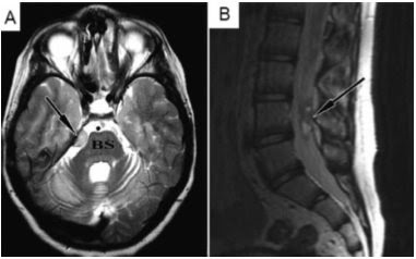 Brain Tumor Mri Images