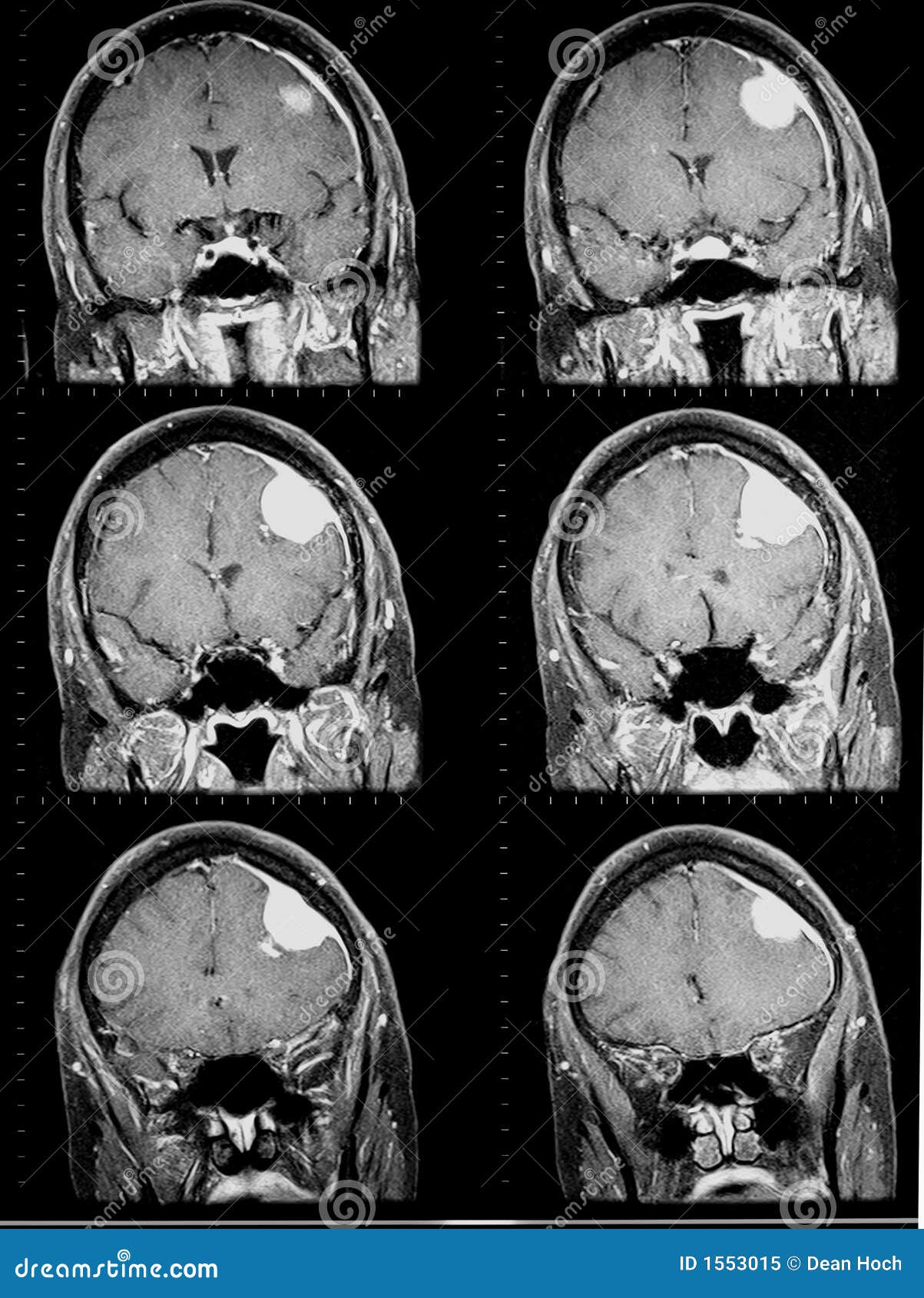 Brain Tumor Mri Images