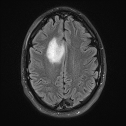 Brain Tumor Mri Images