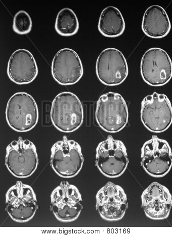 Brain Tumor Mri Images