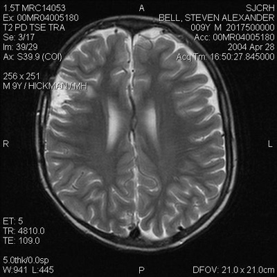 Brain Tumor Mri Images