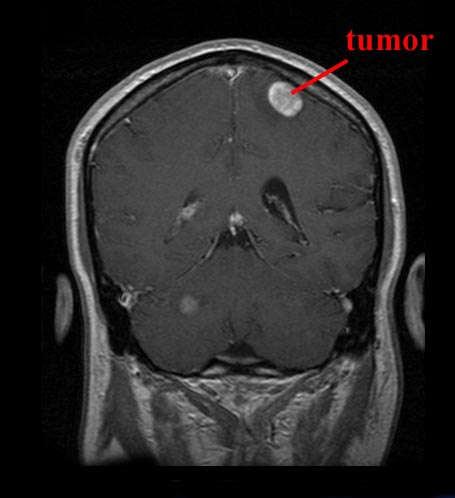 Brain Tumor Mri Images