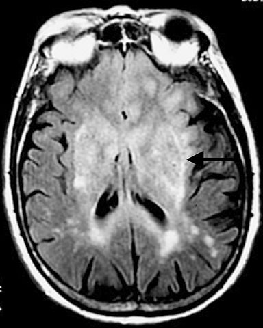 Brain Tumor Mri Or Ct Scan