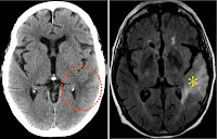 Brain Tumor Mri Or Ct Scan