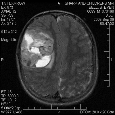 Brain Tumor Mri Pictures