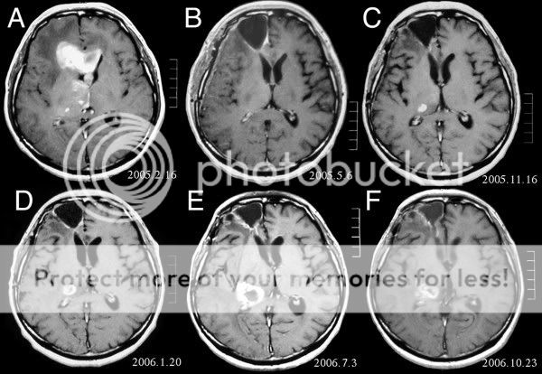 Brain Tumor Mri Pictures