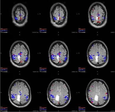 Brain Tumor Mri Results