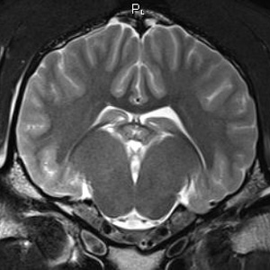 Brain Tumor Mri Results